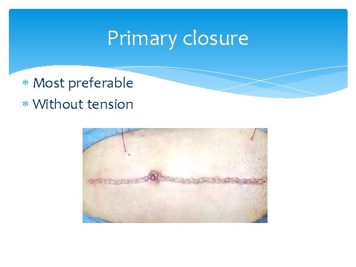 Primary closure Most preferable Without tension Primary closure Most preferable Without tension