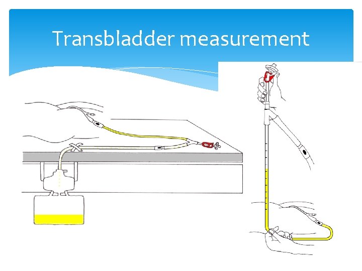 Transbladder measurement Transbladder measurement