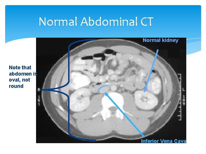 Normal Abdominal CT Normal kidney Note that abdomen is oval, not round Inferior Vena Normal Abdominal CT Normal kidney Note that abdomen is oval, not round Inferior Vena