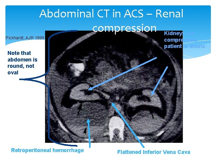 Abdominal CT in ACS – Renal compression Kidneys are Pickhardt, AJR 1999 compressed, patient Abdominal CT in ACS – Renal compression Kidneys are Pickhardt, AJR 1999 compressed, patient