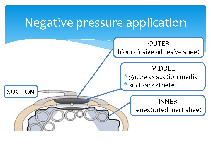 Negative pressure application OUTER bioocclusive adhesive sheet SUCTION MIDDLE * gauze as suction media Negative pressure application OUTER bioocclusive adhesive sheet SUCTION MIDDLE * gauze as suction media