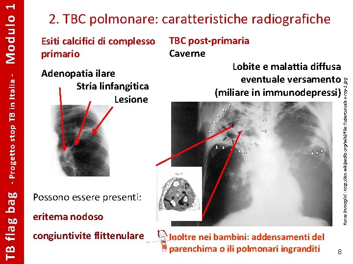 Esiti calcifici di complesso primario Adenopatia ilare Stria linfangitica Lesione TBC post-primaria Caverne Lobite