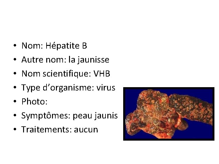  • • Nom: Hépatite B Autre nom: la jaunisse Nom scientifique: VHB Type