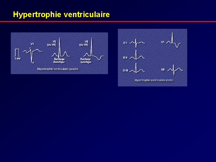 Hypertrophie ventriculaire 