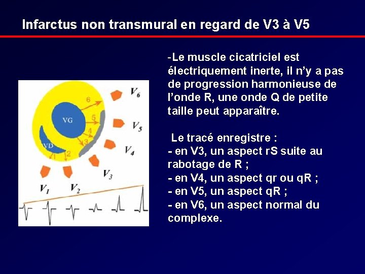 Infarctus non transmural en regard de V 3 à V 5 -Le muscle cicatriciel