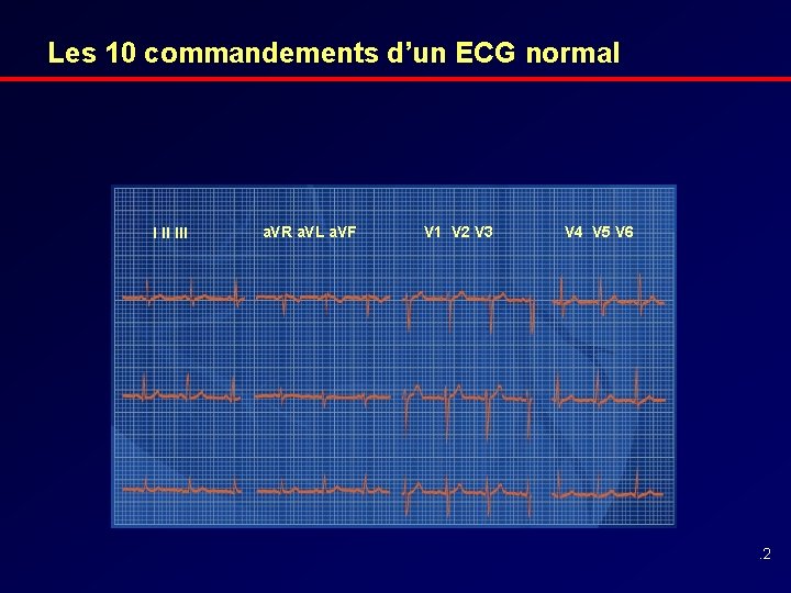 Les 10 commandements d’un ECG normal I II III a. VR a. VL a.