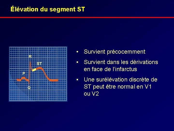 Élévation du segment ST • Survient précocemment R ST P Q • Survient dans