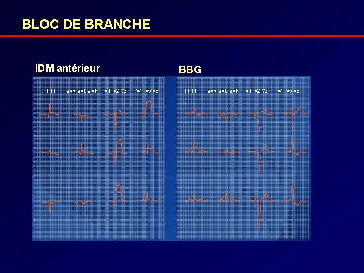 BLOC DE BRANCHE IDM antérieur I II III a. VR a. VL a. VF