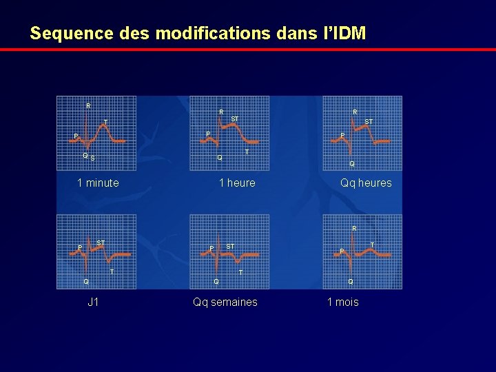 Sequence des modifications dans l’IDM R R T R ST ST P P P