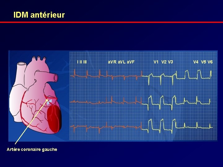 IDM antérieur I II III Artère coronaire gauche a. VR a. VL a. VF