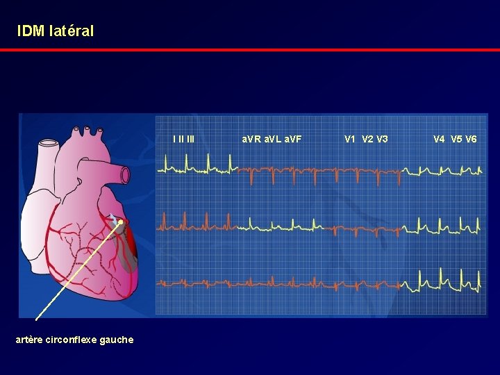 IDM latéral I II III artère circonflexe gauche a. VR a. VL a. VF