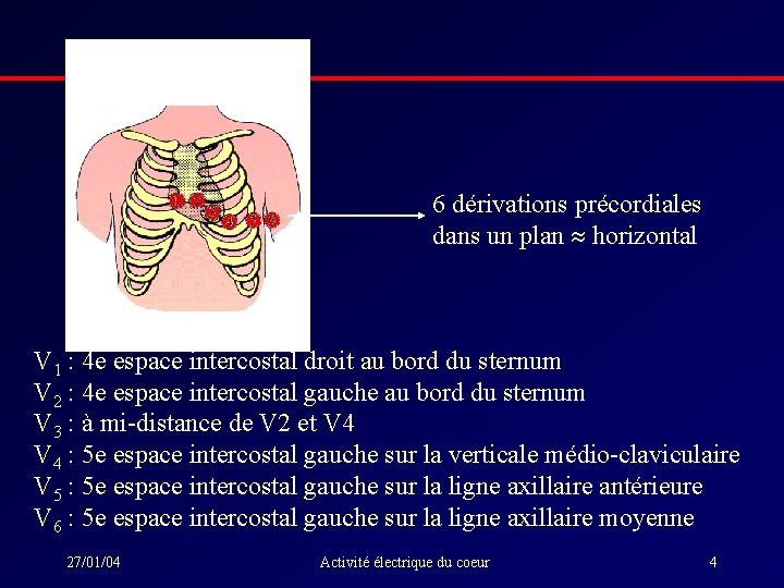 6 dérivations précordiales dans un plan horizontal V 1 : 4 e espace intercostal