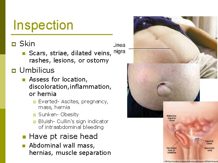 Inspection p Skin n p Scars, striae, dilated veins, rashes, lesions, or ostomy Umbilicus