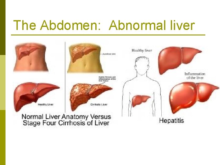 The Abdomen: Abnormal liver 