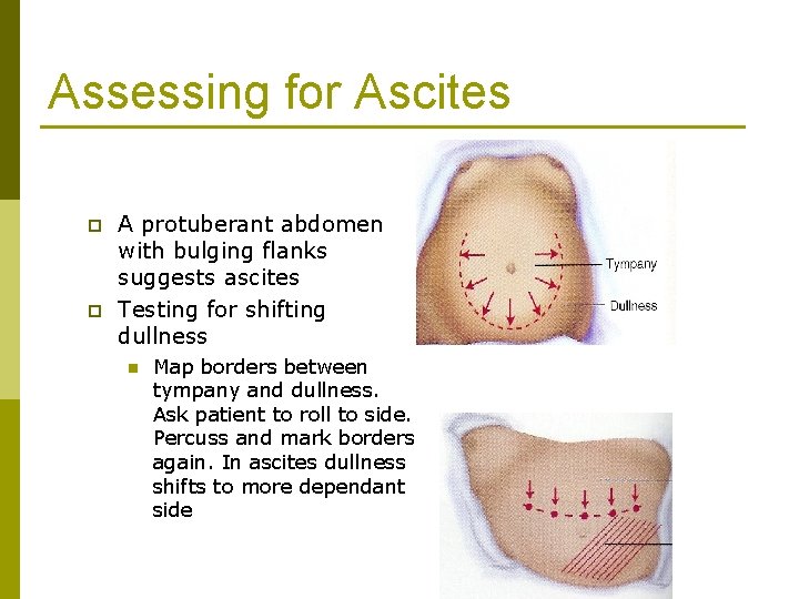 Assessing for Ascites p p A protuberant abdomen with bulging flanks suggests ascites Testing