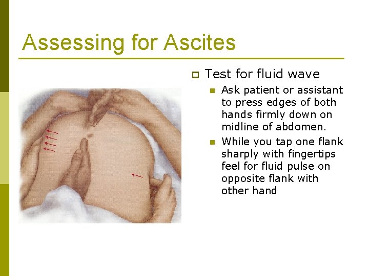 Assessing for Ascites p Test for fluid wave n n Ask patient or assistant