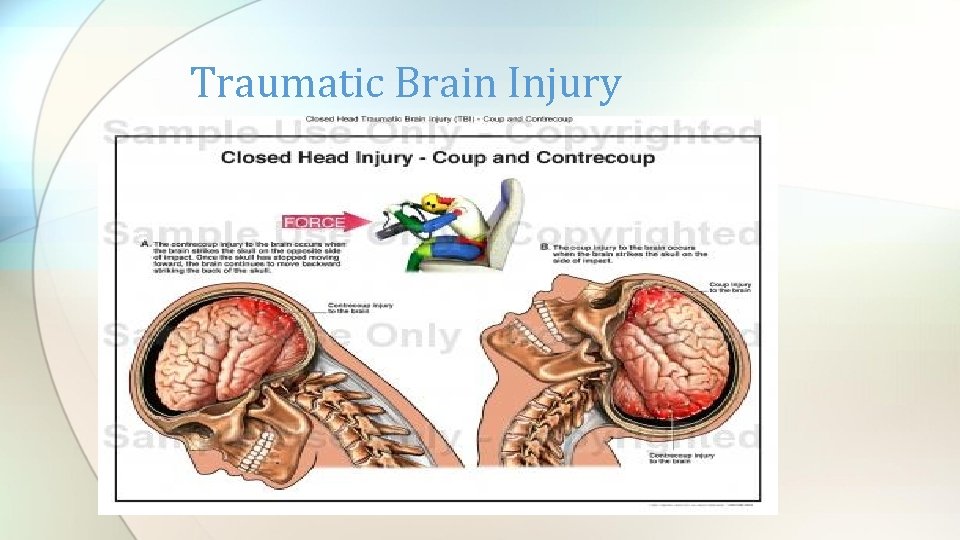 Traumatic Brain Injury 