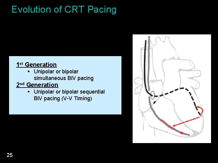 Evolution of CRT Pacing 1 st Generation § Unipolar or bipolar simultaneous Bi. V