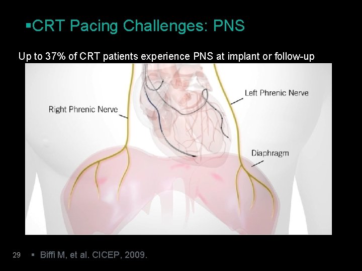 §CRT Pacing Challenges: PNS Up to 37% of CRT patients experience PNS at implant