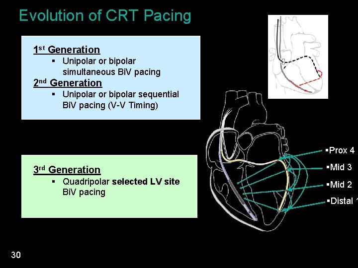 Evolution of CRT Pacing 1 st Generation § Unipolar or bipolar simultaneous Bi. V