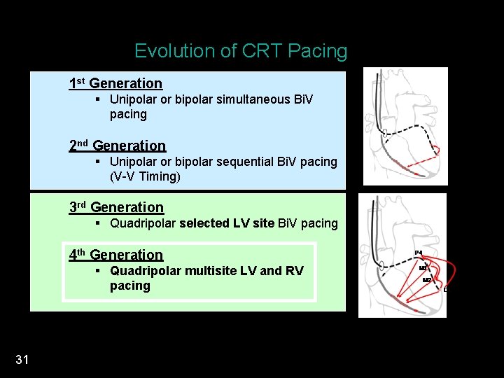 Evolution of CRT Pacing 1 st Generation § Unipolar or bipolar simultaneous Bi. V