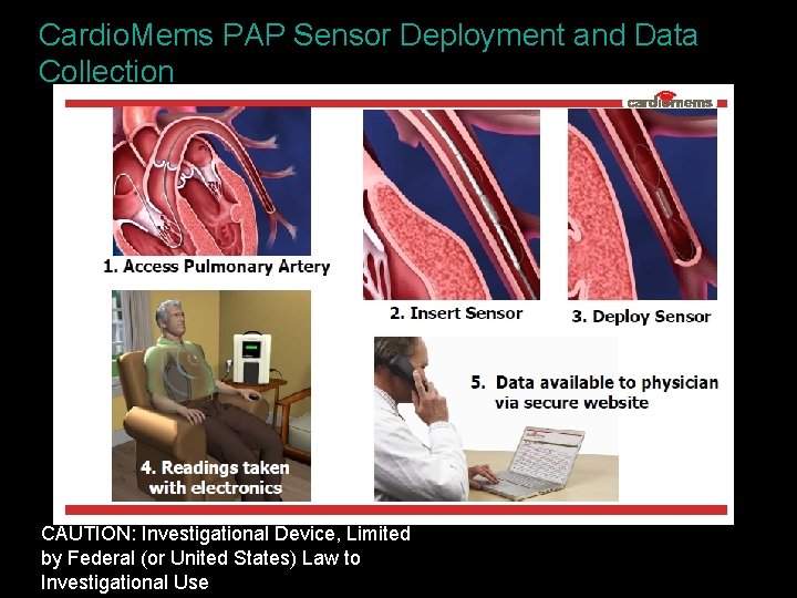 Cardio. Mems PAP Sensor Deployment and Data Collection CAUTION: Investigational Device, Limited by Federal