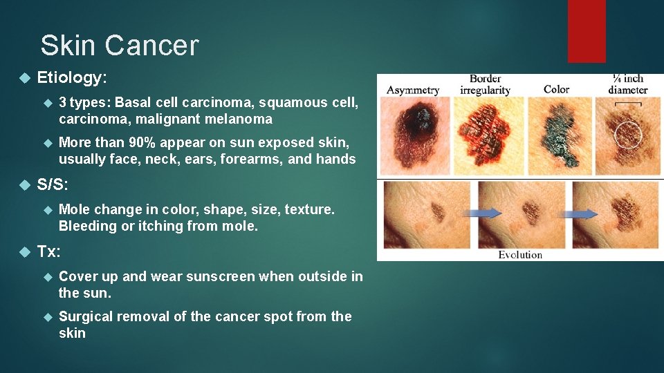 Skin Cancer Etiology: 3 types: Basal cell carcinoma, squamous cell, carcinoma, malignant melanoma More