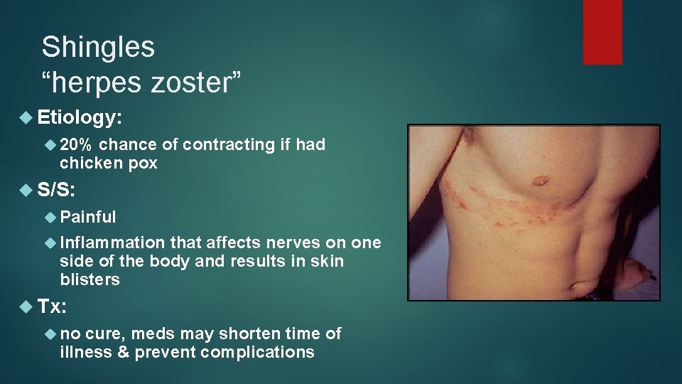 Shingles “herpes zoster” Etiology: 20% chance of contracting if had chicken pox S/S: Painful