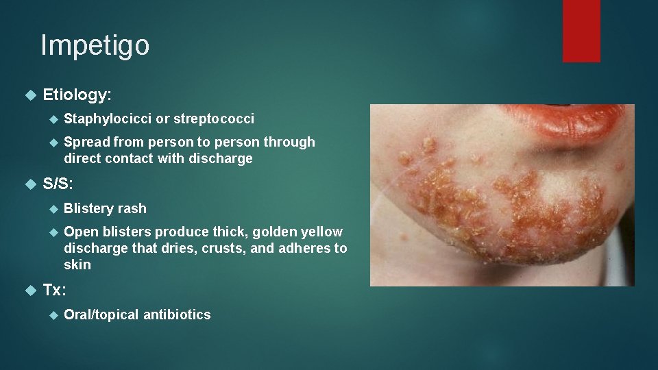 Impetigo Etiology: Staphylocicci or streptococci Spread from person to person through direct contact with