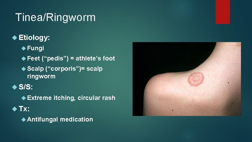 Tinea/Ringworm Etiology: Fungi Feet (“pedis”) = athlete’s foot Scalp (“corporis”)= scalp ringworm S/S: Extreme
