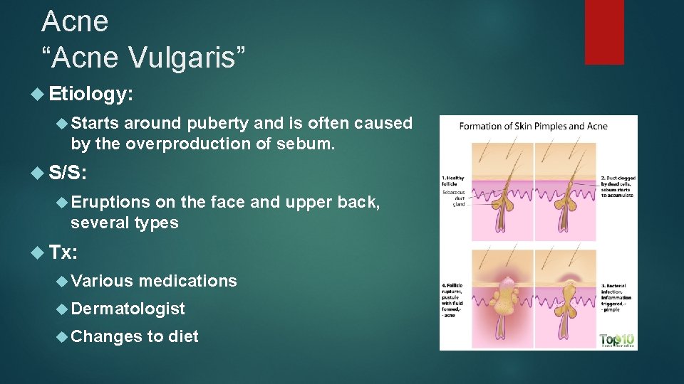 Acne “Acne Vulgaris” Etiology: Starts around puberty and is often caused by the overproduction
