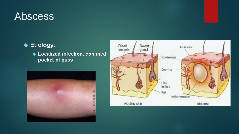 Abscess Etiology: Localized infection, confined pocket of puss 