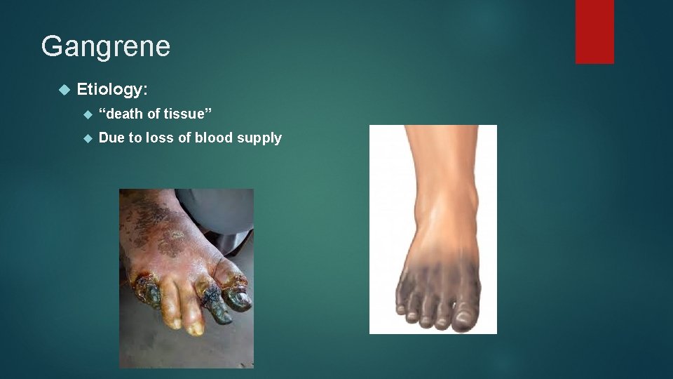 Gangrene Etiology: “death of tissue” Due to loss of blood supply 