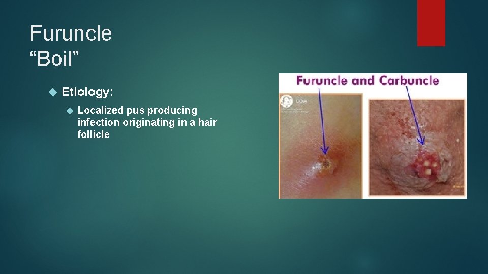 Furuncle “Boil” Etiology: Localized pus producing infection originating in a hair follicle 