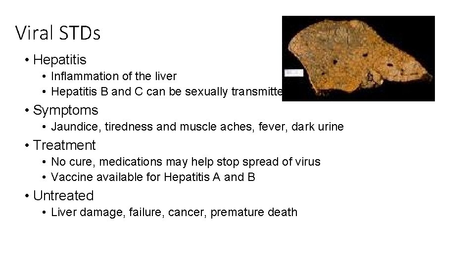 Viral STDs • Hepatitis • Inflammation of the liver • Hepatitis B and C