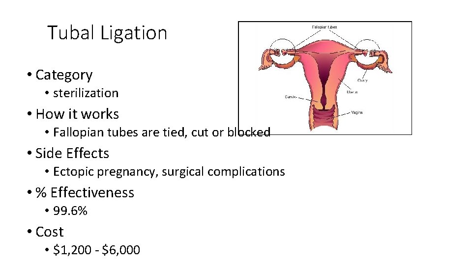 Tubal Ligation • Category • sterilization • How it works • Fallopian tubes are
