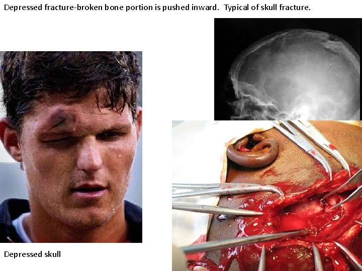 Depressed fracture-broken bone portion is pushed inward. Typical of skull fracture. Depressed skull 