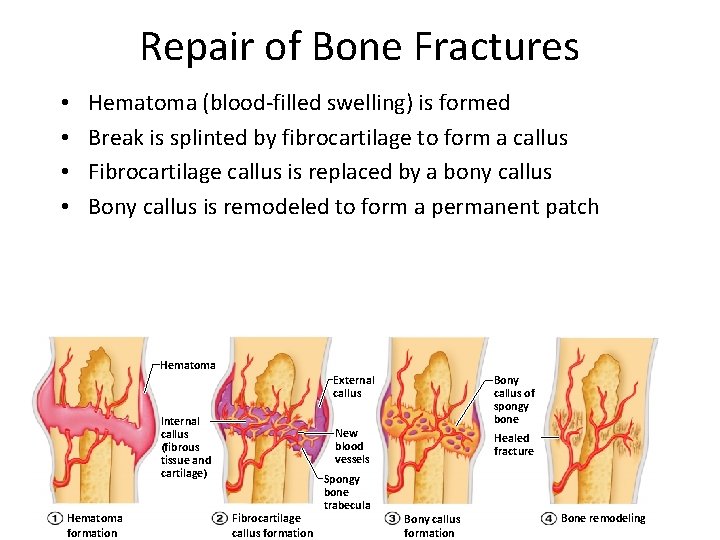 Repair of Bone Fractures • • Hematoma (blood-filled swelling) is formed Break is splinted