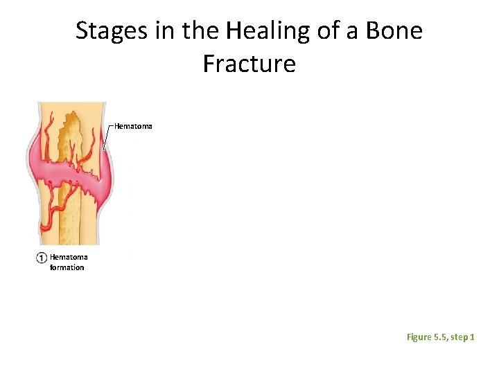 Stages in the Healing of a Bone Fracture Hematoma formation Figure 5. 5, step