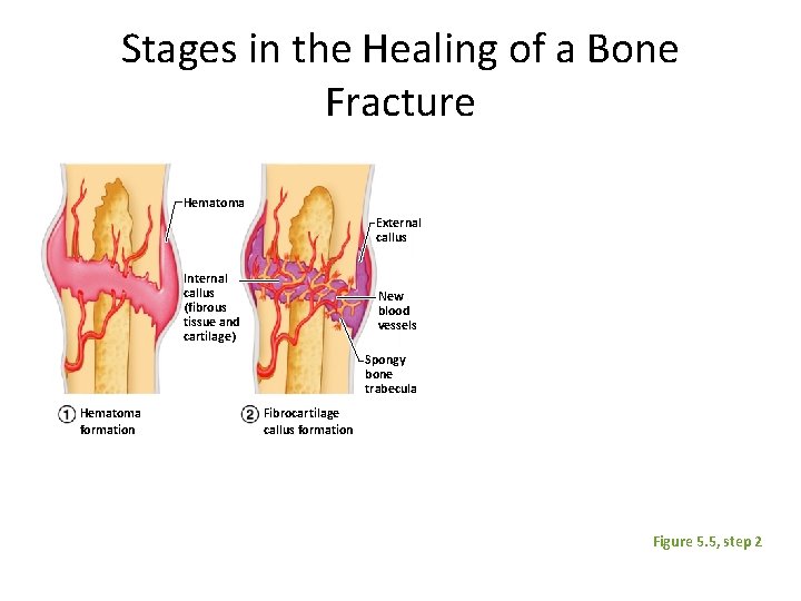 Stages in the Healing of a Bone Fracture Hematoma External callus Internal callus (fibrous