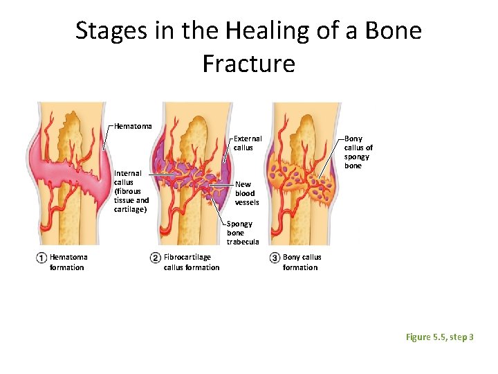 Stages in the Healing of a Bone Fracture Hematoma External callus Internal callus (fibrous