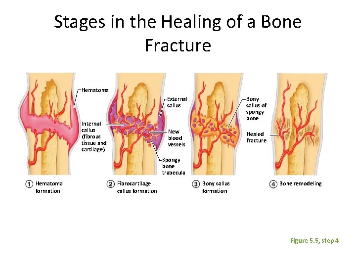 Stages in the Healing of a Bone Fracture Hematoma Internal callus (fibrous tissue and