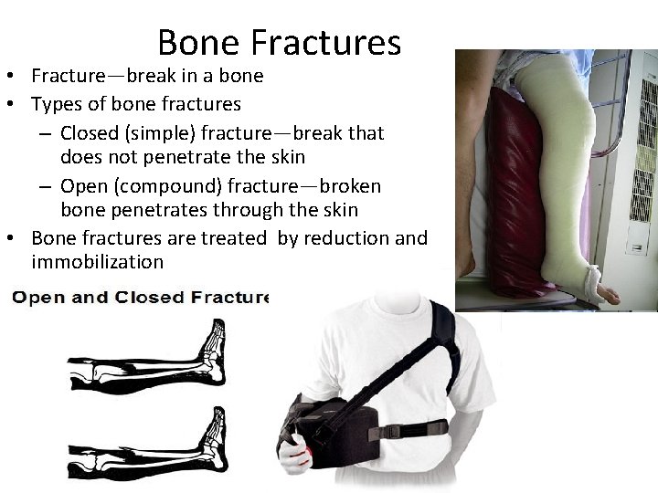 Bone Fractures • Fracture—break in a bone • Types of bone fractures – Closed