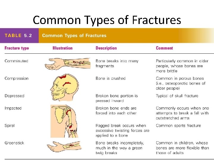 Common Types of Fractures Table 5. 2 