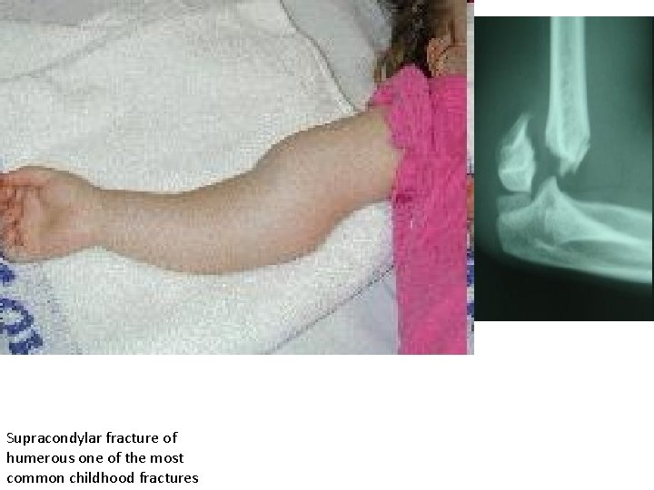 Supracondylar fracture of humerous one of the most common childhood fractures 