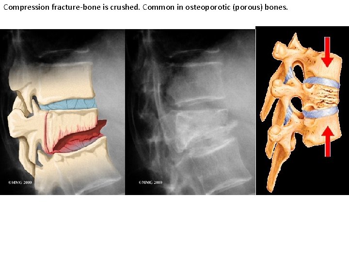 Compression fracture-bone is crushed. Common in osteoporotic (porous) bones. 