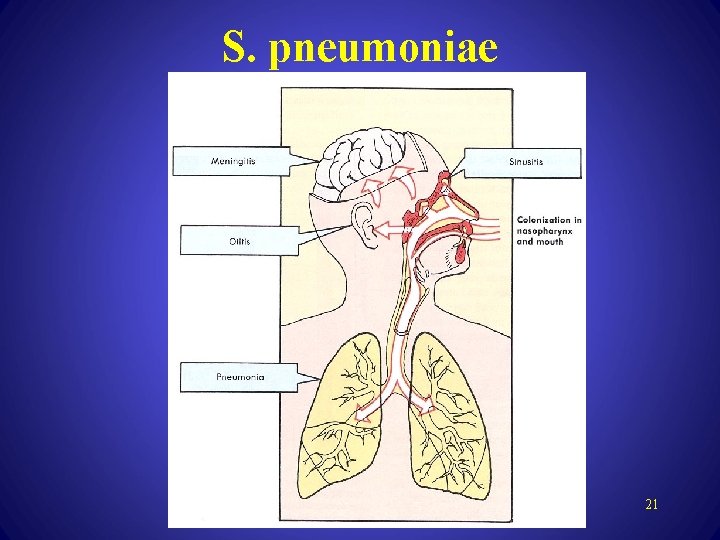 S. pneumoniae 21 