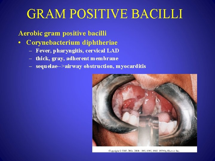 GRAM POSITIVE BACILLI Aerobic gram positive bacilli • Corynebacterium diphtheriae – Fever, pharyngitis, cervical