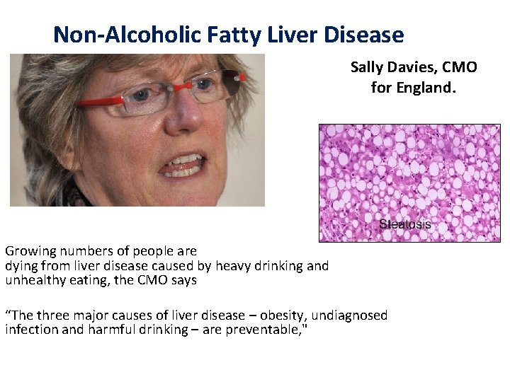 Non-Alcoholic Fatty Liver Disease Sally Davies, CMO for England. Growing numbers of people are