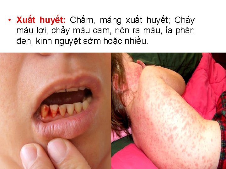 • Xuất huyết: Chấm, mảng xuất huyết; Chảy máu lợi, chảy máu cam, • Xuất huyết: Chấm, mảng xuất huyết; Chảy máu lợi, chảy máu cam,